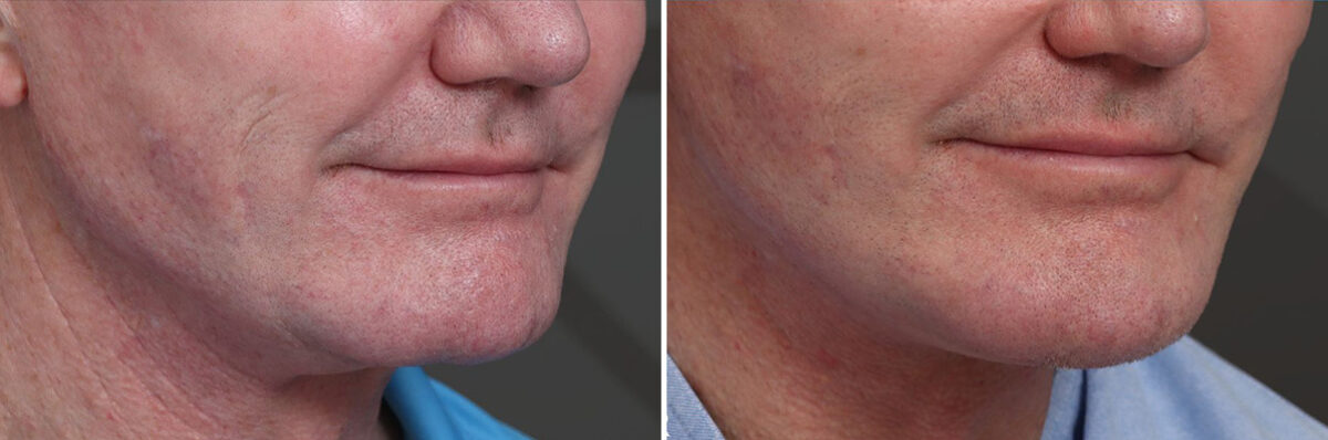 Chin Implants Before and After Photos in Princeton, NJ, Patient 19005
