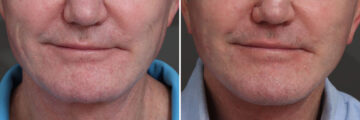 Chin Implants Before and After Photos in Princeton, NJ, Patient 19005