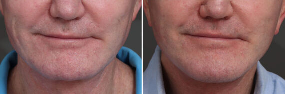 Chin Implants Before and After Photos in Princeton, NJ, Patient 19005