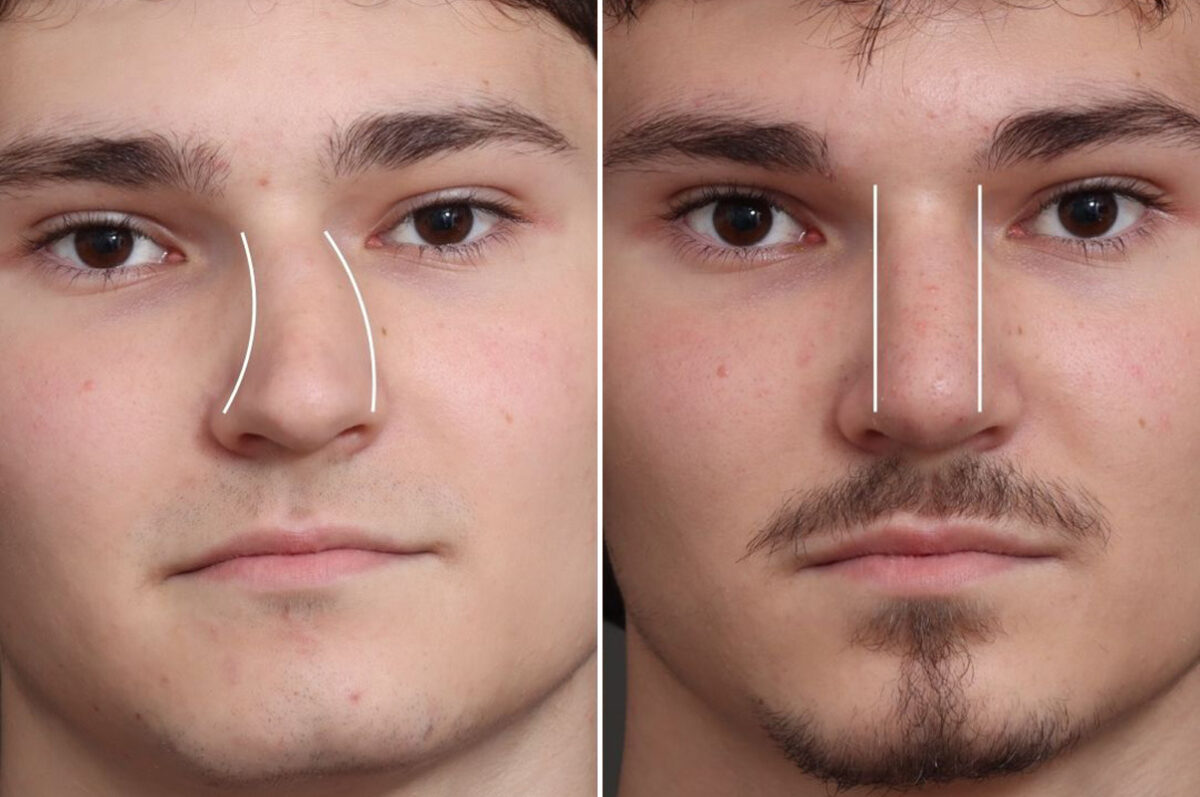 Rhinoplasty Before and After Photos in Princeton, NJ, Patient 19218