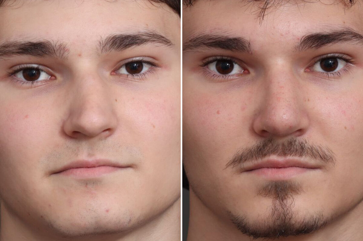 Rhinoplasty Before and After Photos in Princeton, NJ, Patient 19218