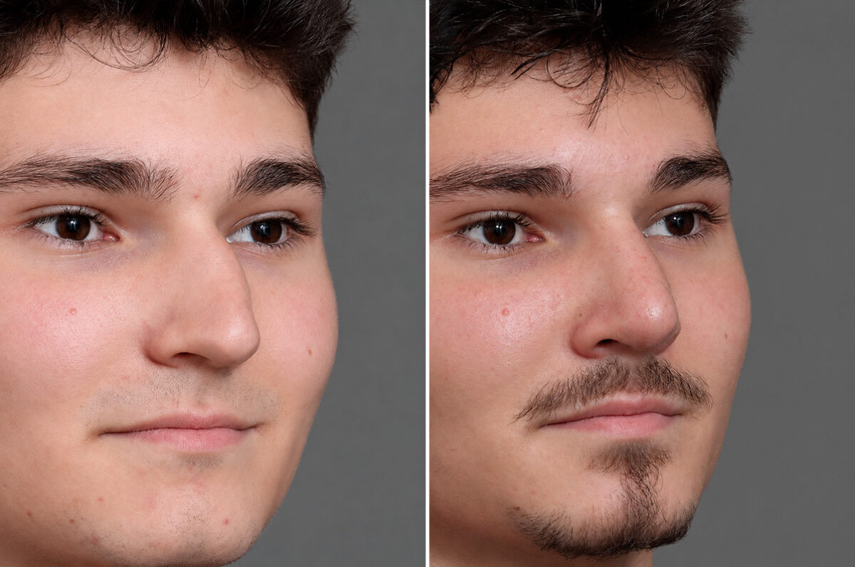 Rhinoplasty Before and After Photos in Princeton, NJ, Patient 19218