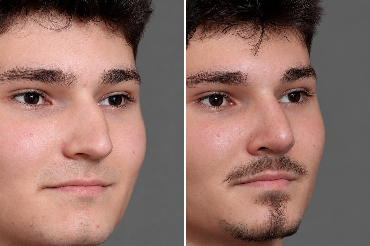 patient-19218-rhinoplasty-before-after