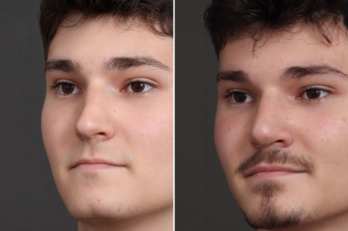 Rhinoplasty Before and After Photos in Princeton, NJ, Patient 19218