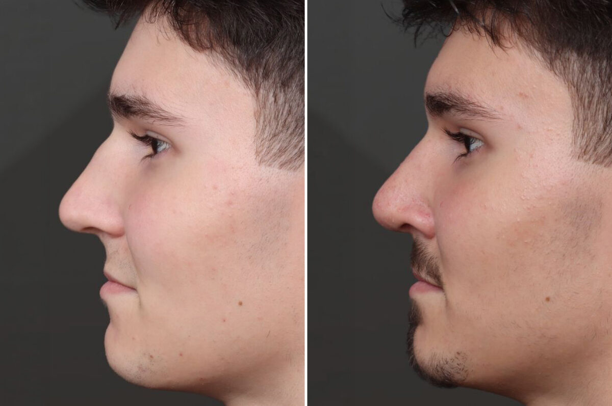 Rhinoplasty Before and After Photos in Princeton, NJ, Patient 19218