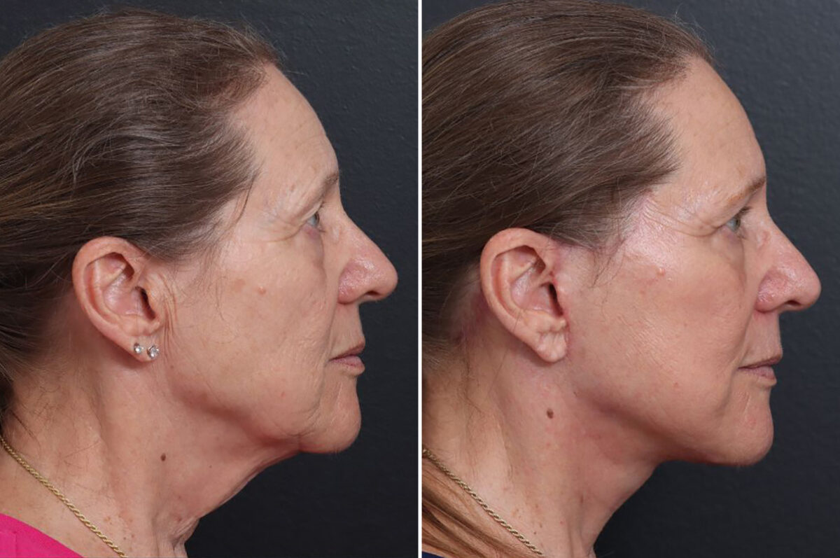 Facelift Before and After Photos in Princeton, NJ, Patient 19262