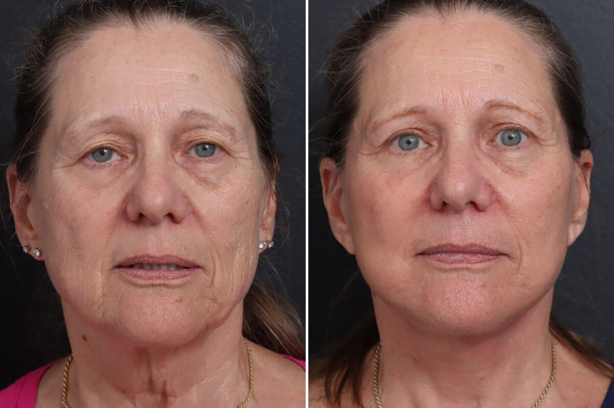 Facelift Before and After Photos in Princeton, NJ, Patient 19262