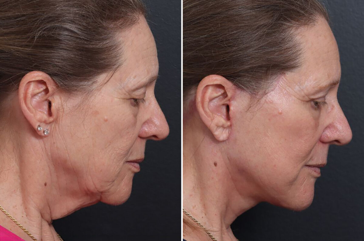 Facelift Before and After Photos in Princeton, NJ, Patient 19262