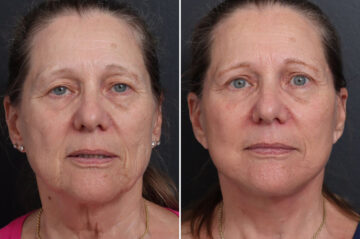 Facelift Before and After Photos in Princeton, NJ, Patient 19262