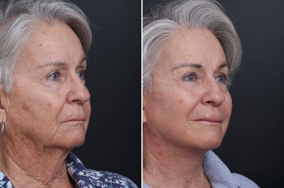 Deep Plane Facelift Before and After Photos in Princeton, NJ, Patient 19267