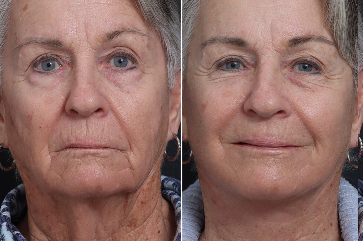 Deep Plane Facelift Before and After Photos in Princeton, NJ, Patient 19267