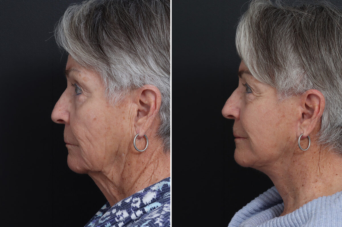 Deep Plane Facelift Before and After Photos in Princeton, NJ, Patient 19267