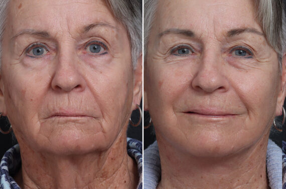 Deep Plane Facelift Before and After Photos in Princeton, NJ, Patient 19267