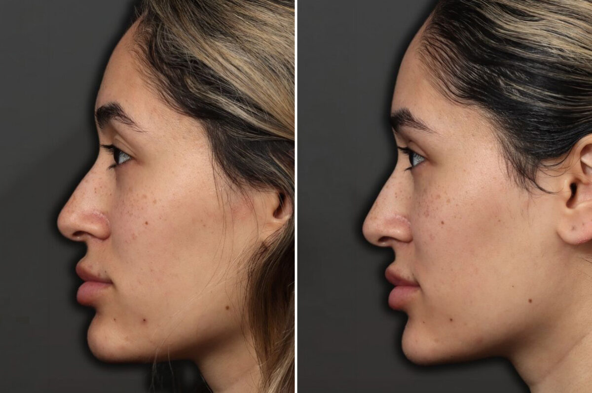 Upper Eyelid Surgery Before and After Photos in Princeton, NJ, Patient 19271