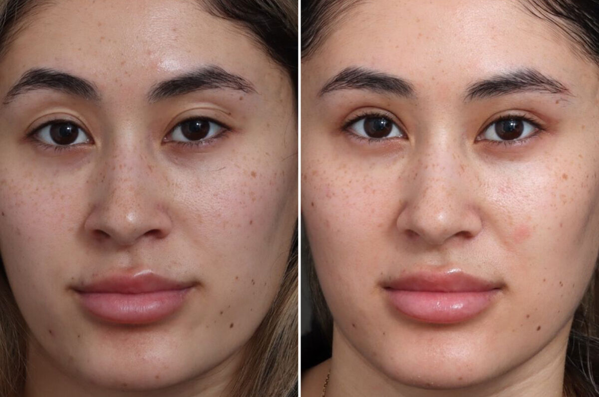 Upper Eyelid Surgery Before and After Photos in Princeton, NJ, Patient 19271