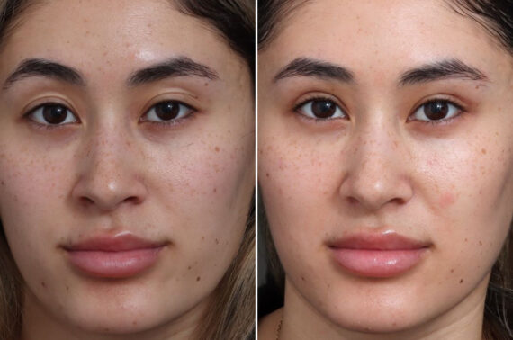 Upper Eyelid Surgery Before and After Photos in Princeton, NJ, Patient 19271