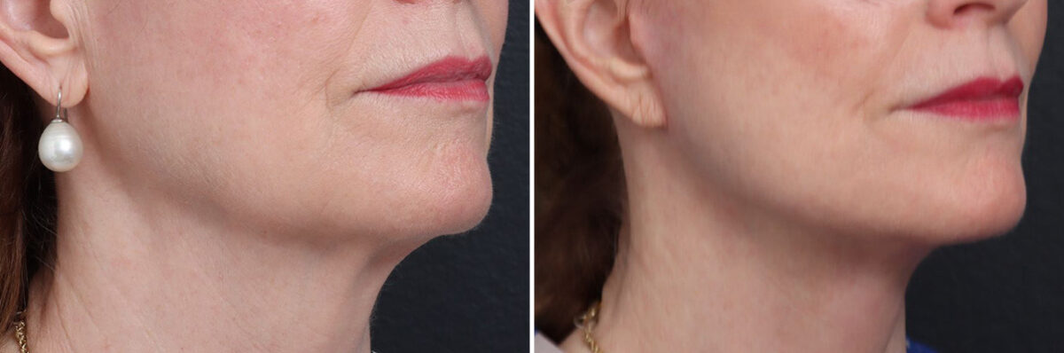 Facelift Before and After Photos in Princeton, NJ, Patient 19274