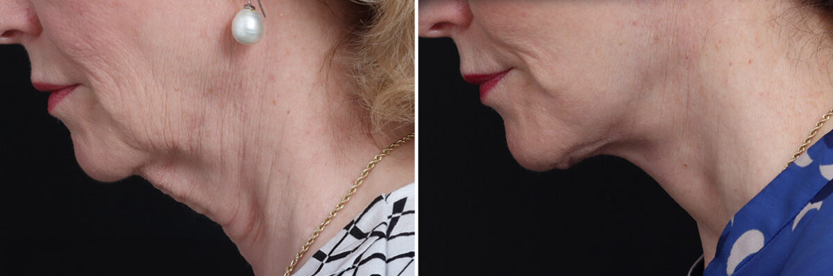 Facelift Before and After Photos in Princeton, NJ, Patient 19274
