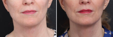 Facelift Before and After Photos in Princeton, NJ, Patient 19274
