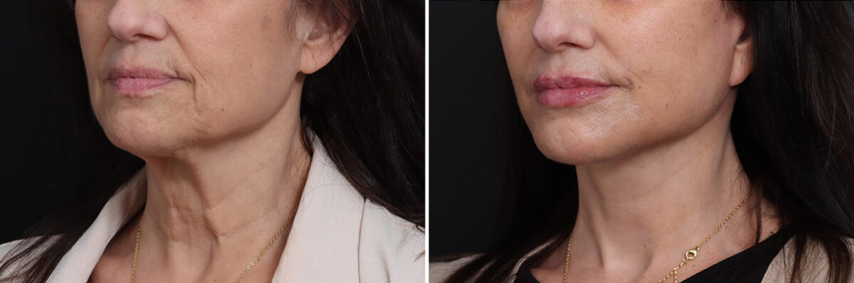 Deep Plane Facelift Before and After Photos in Princeton, NJ, Patient 19278