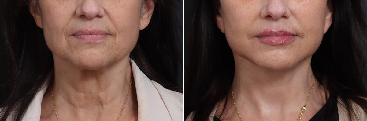 Deep Plane Facelift Before and After Photos in Princeton, NJ, Patient 19278