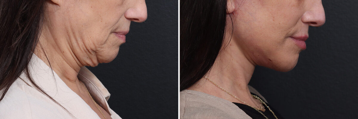 Deep Plane Facelift Before and After Photos in Princeton, NJ, Patient 19278