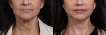 Deep Plane Facelift Before and After Photos in Princeton, NJ, Patient 19278