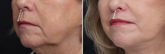 Lip Lift Before and After Photos in Princeton, NJ, Patient 19286