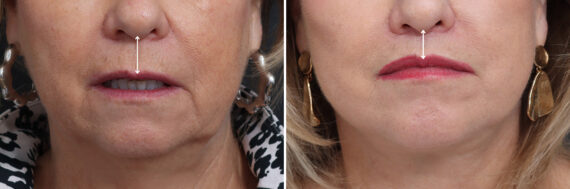Lip Lift Before and After Photos in Princeton, NJ, Patient 19286