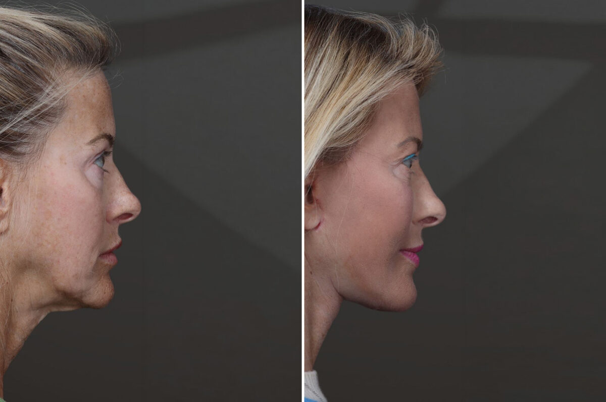 Deep Plane Facelift Before and After Photos in Princeton, NJ, Patient 19327