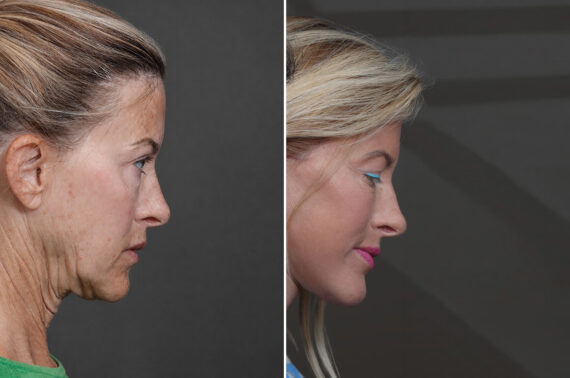 Deep Plane Facelift Before and After Photos in Princeton, NJ, Patient 19327