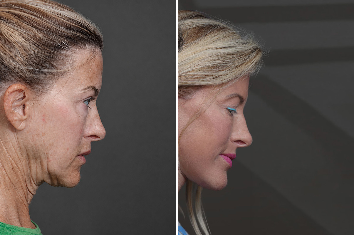 patient-19327-deep-plane-facelift-before-after