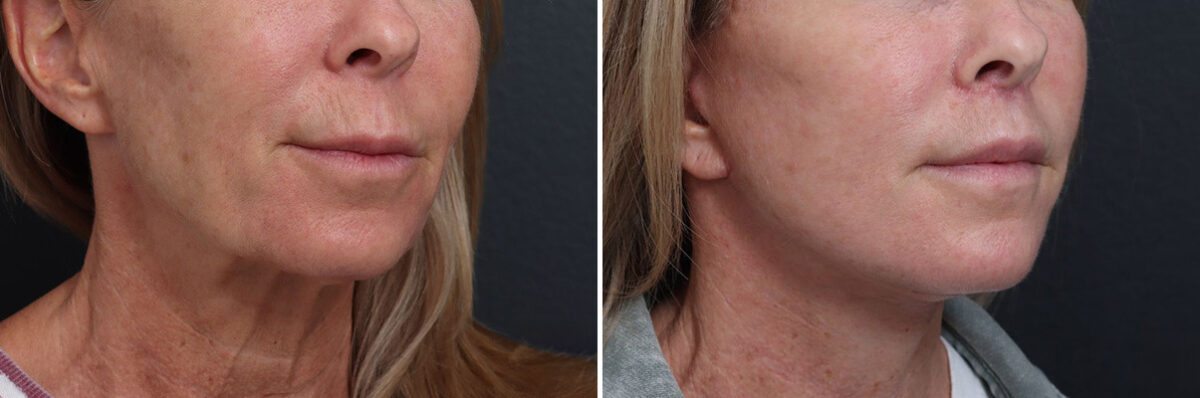 Facelift Before and After Photos in Princeton, NJ, Patient 19330
