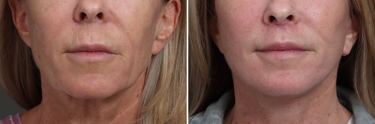 Facelift Before and After Photos in Princeton, NJ, Patient 19330