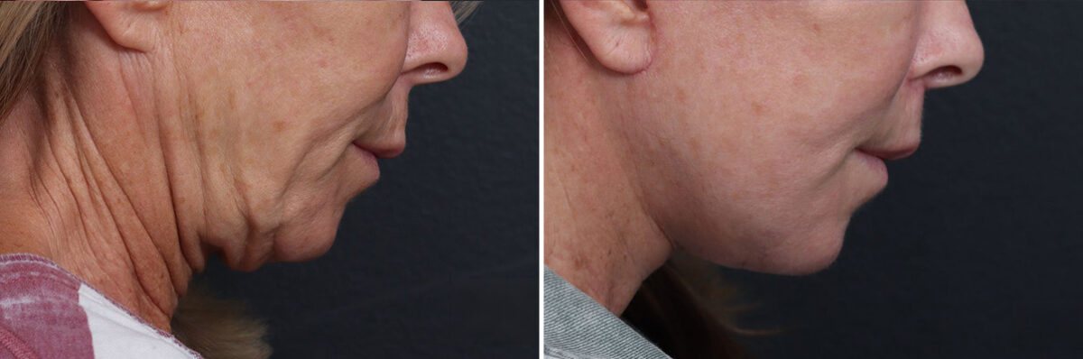 Facelift Before and After Photos in Princeton, NJ, Patient 19330
