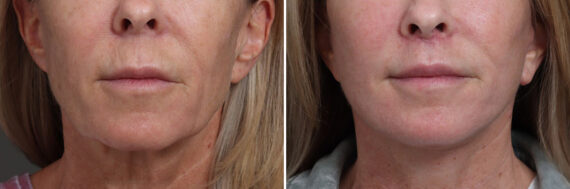 Lip Lift Before and After Photos in Princeton, NJ