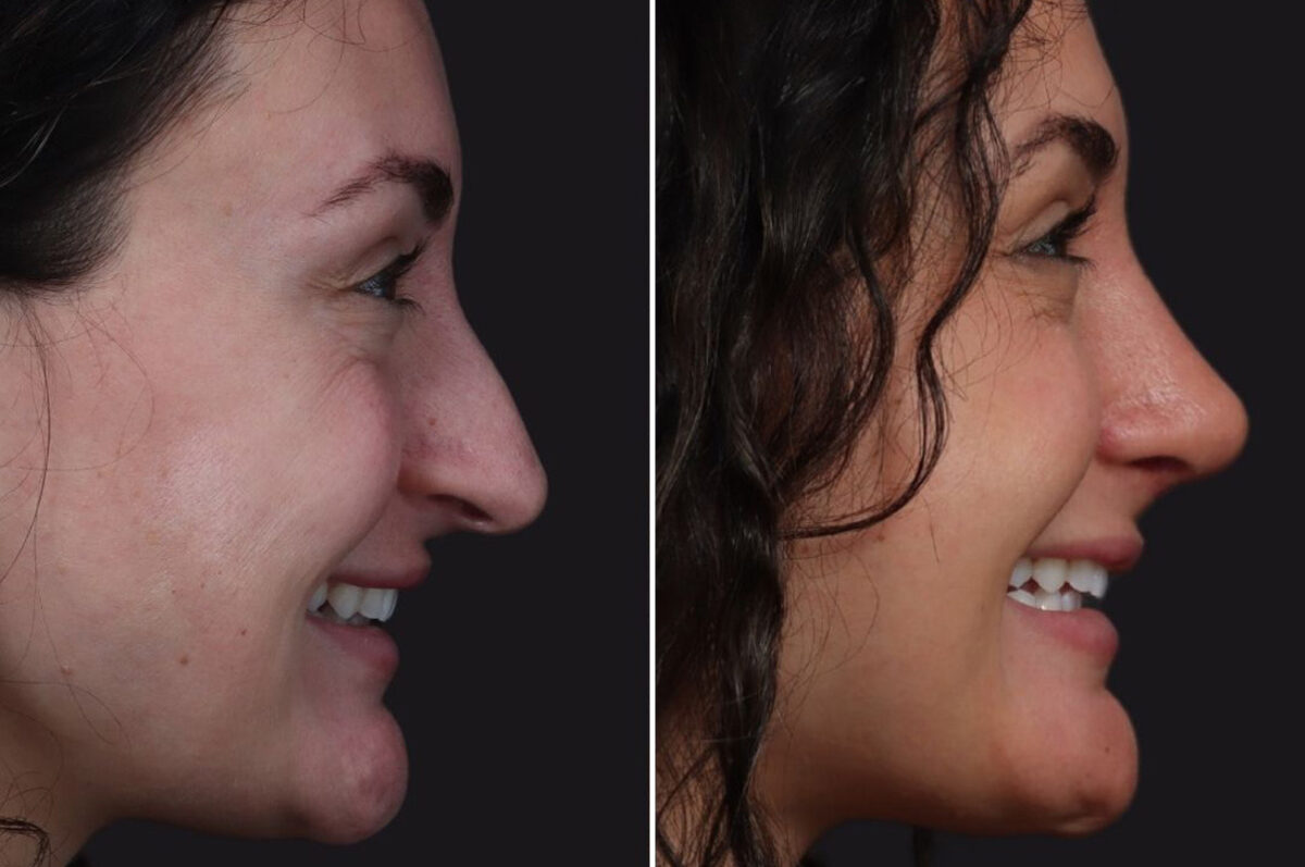 Rhinoplasty Before and After Photos in Princeton, NJ, Patient 19334
