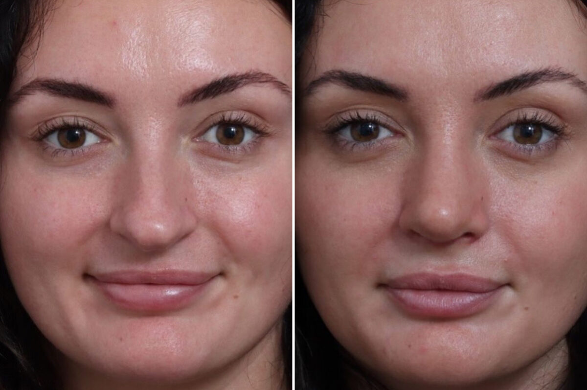 Rhinoplasty Before and After Photos in Princeton, NJ, Patient 19334