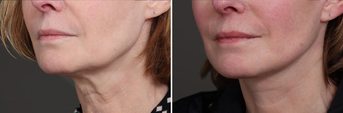 Facelift Before and After Photos in Princeton, NJ, Patient 19337