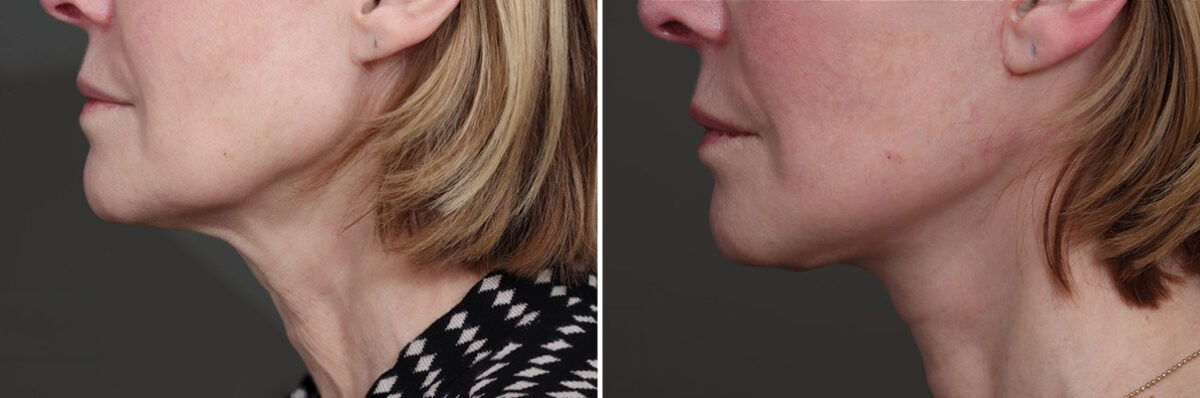 Facelift Before and After Photos in Princeton, NJ, Patient 19337