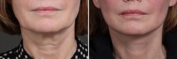 Facelift Before and After Photos in Princeton, NJ, Patient 19337