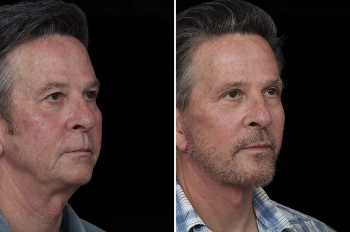 Chin Implants Before and After Photos in Princeton, NJ, Patient 19341