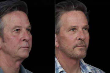 Chin Implants Before and After Photos in Princeton, NJ, Patient 19341