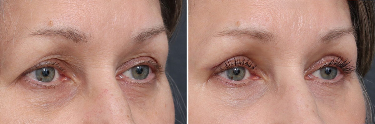 Upper Eyelid Surgery Before and After Photos in Princeton, NJ, Patient 19343