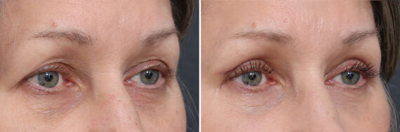 Upper Eyelid Surgery Before and After Photos in Princeton, NJ, Patient 19343