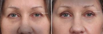 Upper Eyelid Surgery Before and After Photos in Princeton, NJ, Patient 19343