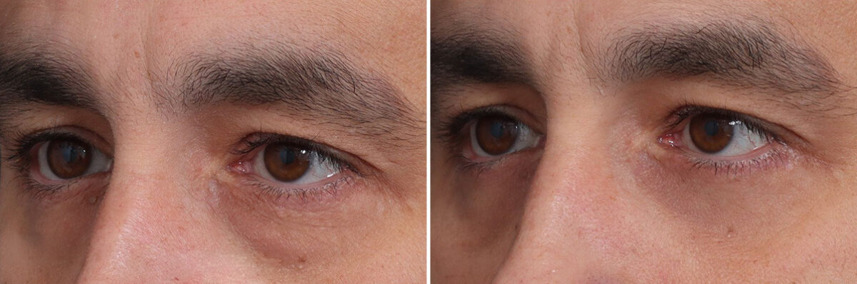 Fat Grafting Before and After Photos in Princeton, NJ, Patient 19346