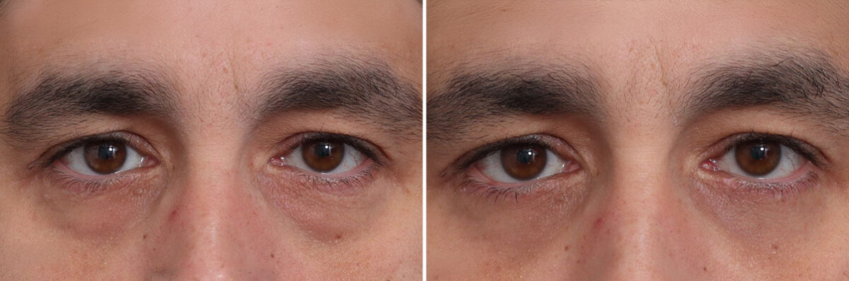 Fat Grafting Before and After Photos in Princeton, NJ, Patient 19346