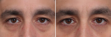 Fat Grafting Before and After Photos in Princeton, NJ, Patient 19346