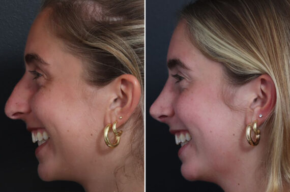 Rhinoplasty Before and After Photos in Princeton, NJ, Patient 19349